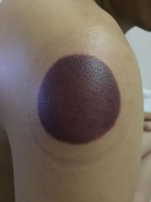 追问 这个是手臂上发 最黑的  本回答由提问者推荐 1