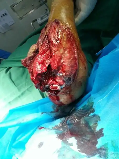 如此复杂的肘关节骨折,你会怎么处理 [病例帖]