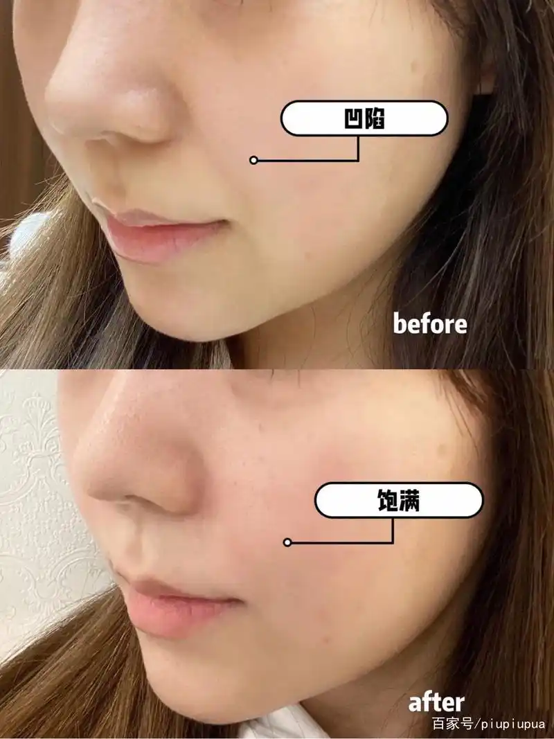 玻尿酸填充鼻基底半年竟然是这种效果!