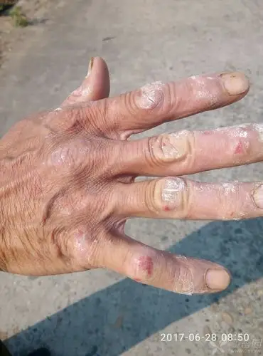 06-28 10:25 像是水泥砂浆造成的,不能排除是否有真菌感染的可能