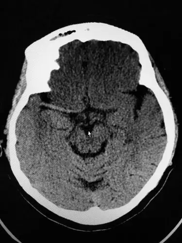 右侧大面积脑梗死,可见右大脑中动脉高密度征,提示血栓形成