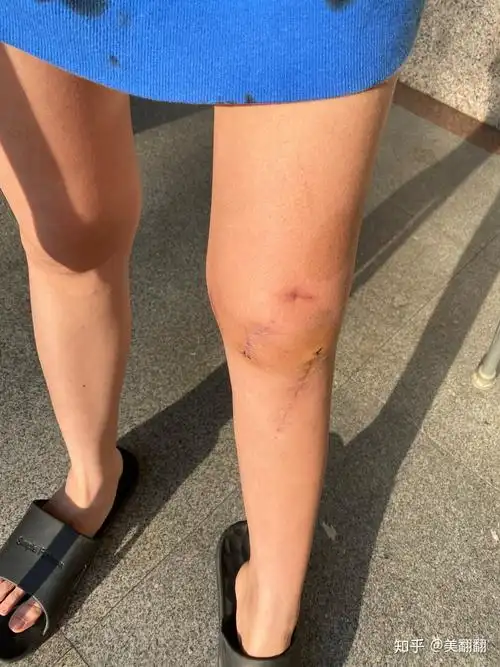 左脚髌骨脱位 关节镜松解回忆录 - 知乎