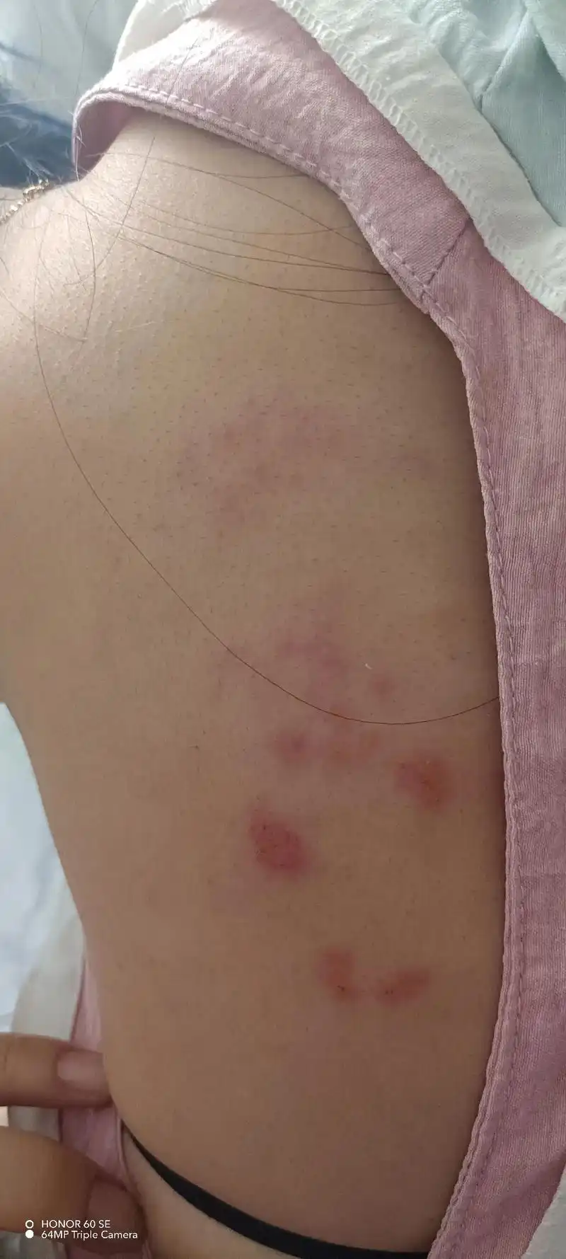 病不大几个泡泡,痛得抓心挠肝,谁能体会…带状病毒性疱疹挂水第六天