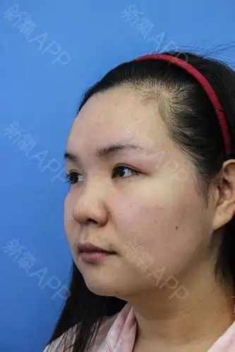 没错,我手术前的样子就是这么惊悚   蒜头鼻,塌鼻梁,再加上