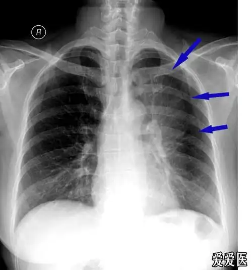 发张典型的左肺上叶不张的图片,大家看下哈 - 医学影像学讨论版 - 爱