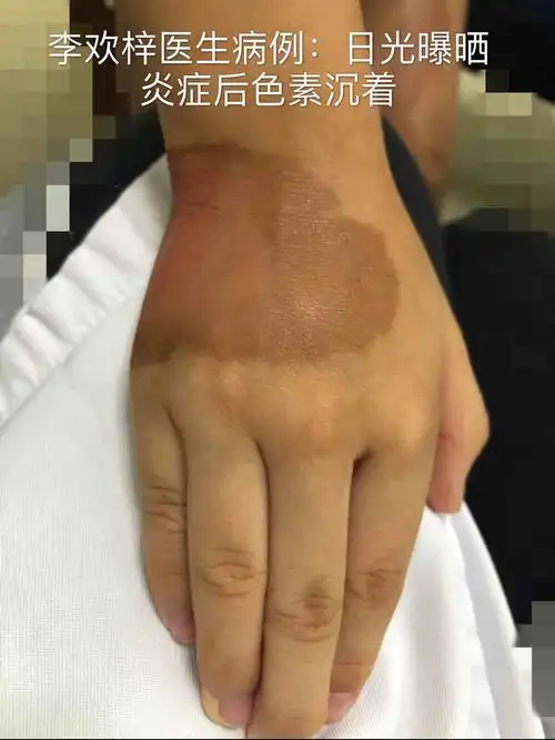 炎症后色素沉着