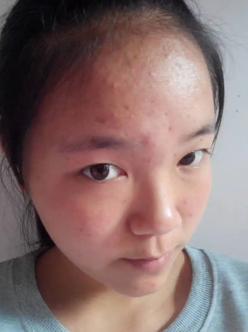 我脸上的痘痘怎么办有没有什么办法?