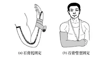 骨折的固定