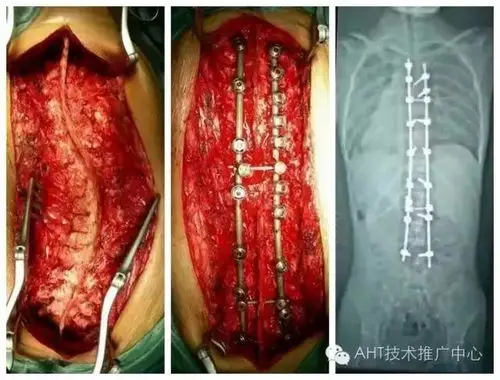 3月1822日aht颈椎胸椎及脊柱侧弯矫正课程