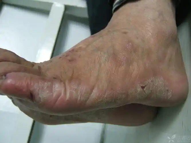 30年病史的-----手脚角化皲裂性湿疹,寻求好治法 - 皮肤性病 -丁香园