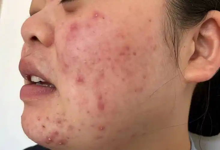 青春痘其实也是一种皮肤病,不及时治疗危害很大_影响_问题_进行