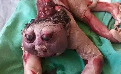 医院诞生半怪物半人身婴儿 畸形种吓死宝宝!