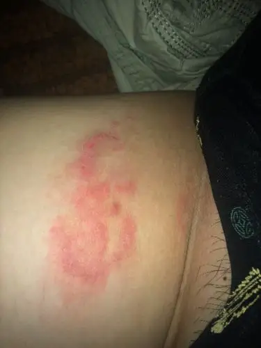 大腿根部又痛又痒,擦地塞米松软膏更严重.求帮助