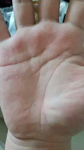 手心有一个个小白点