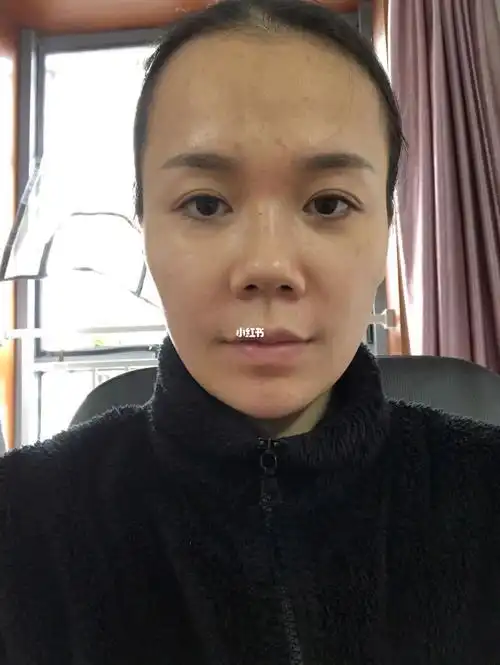 这个玻尿酸下巴算不算整容失败