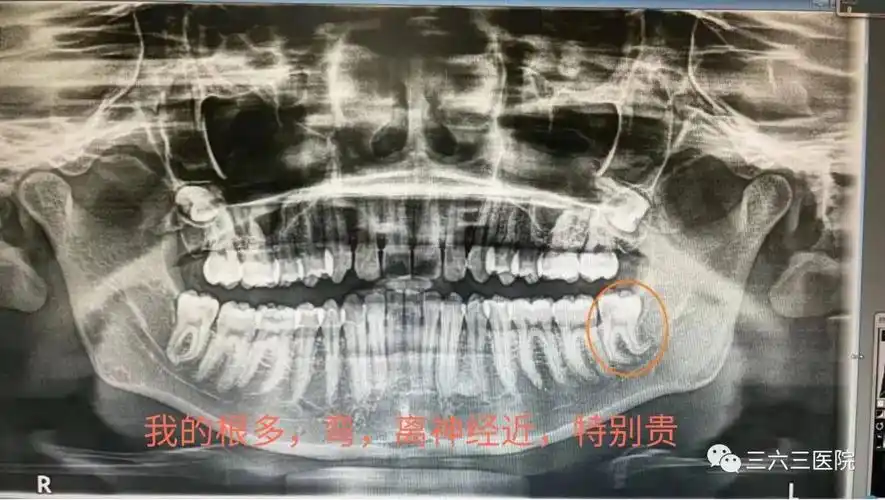 拍摄"全景片",有时还会拍摄口腔cbct,预估智齿的位置,牙根数目及形态