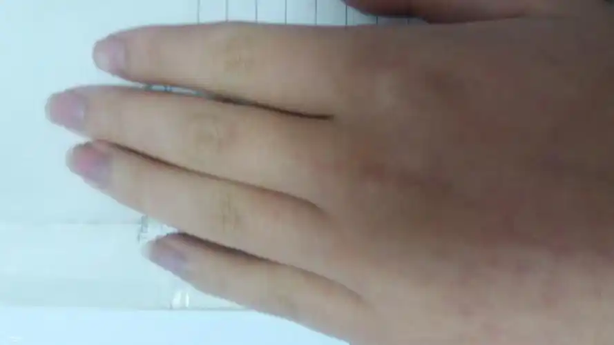 手冻的发黑了手指甲都发紫了