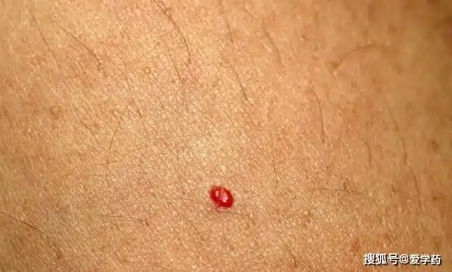 身上有这种小红痣,千万别大意,或是大病的预警信号_手机搜狐网