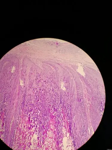跖疣?讨论病例【91360.软组织348】 - 软组织病理 - 91360病理论坛