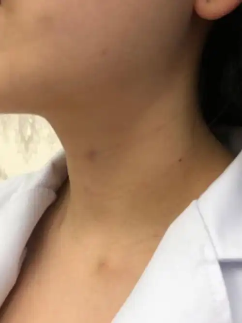 做完嗨体去颈纹的即刻和第五天脖子恢复起来有淤青和泛_圈子-新氧美容