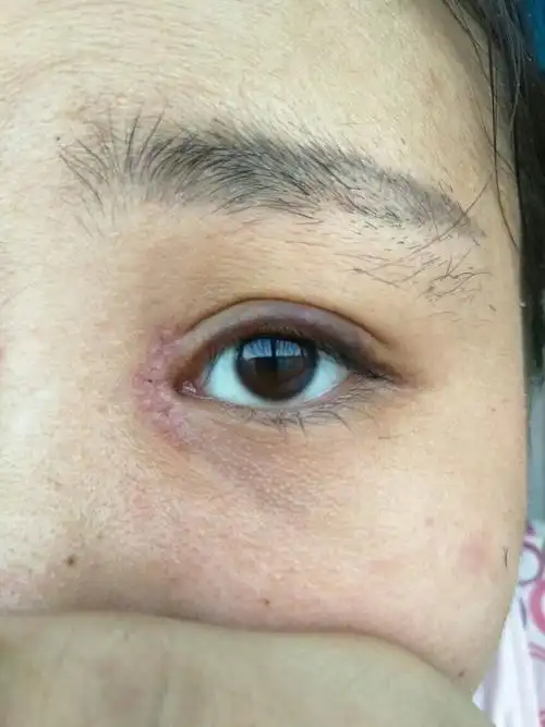 做了开眼角有疤痕图