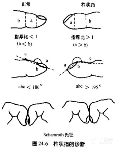 怎样才算是杵状指?具体以哪个位置来算?让精典图文来告诉你!