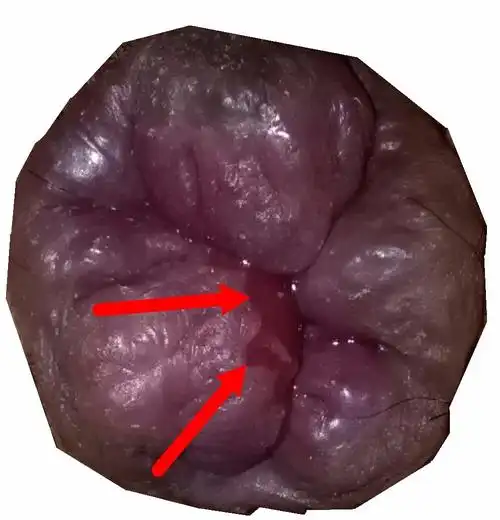 这个是什么问题,肛门内溃疡吗?