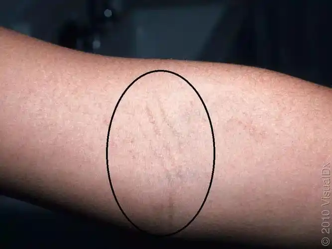 褪色,这种密集的皮疹经常呈线状排列,称为帕氏线(是个姓帕的人命名的)