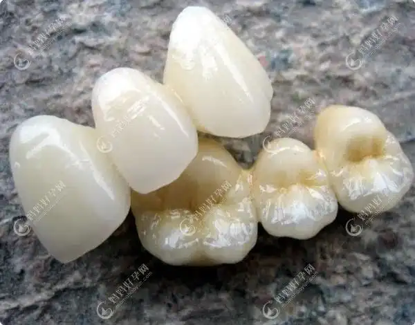 固定假牙的种类及价格详细介绍:来看看固定义齿有几种类型-儿牙-妈妈