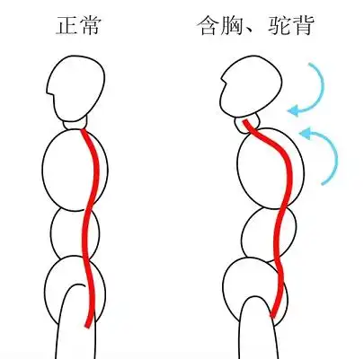 正常体态和含胸驼背对比图