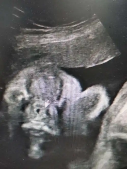 超声诊断胎儿唇腭裂