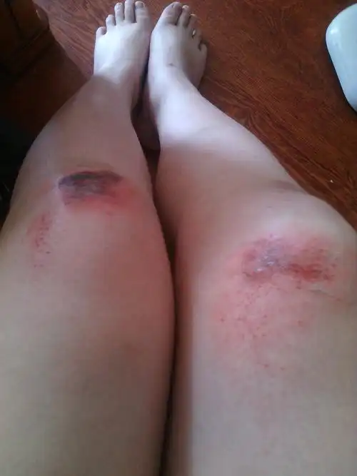 我腿在三天前摔伤我一直用双氧水擦伤口好像有一点化脓了请