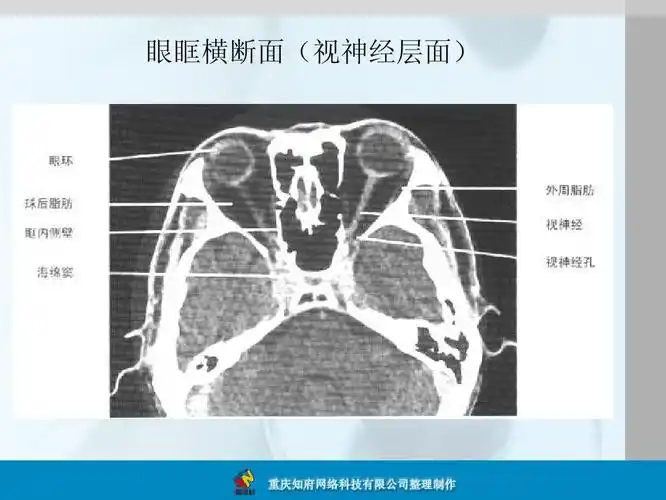 正常眼眶ct解剖图谱