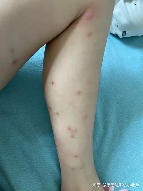被跳蚤咬的全身都是包是什么样的感受! - 知乎