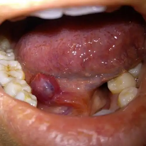 请问这是不是舌下腺囊肿,该怎么治疗?