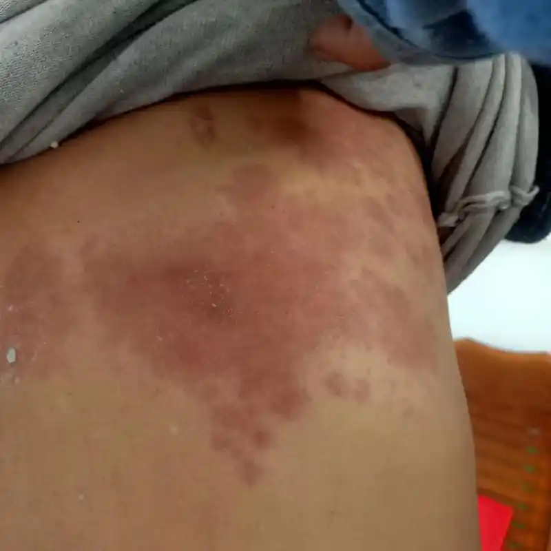 我们俗称的蛇胆疮,蛇蛋疮,可以发生在身体上的任何一个部位, - 抖音