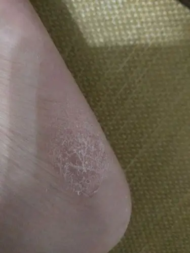 长了半个月了,不痛不痒,一直掉皮