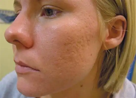 橘皮样皮肤图片45