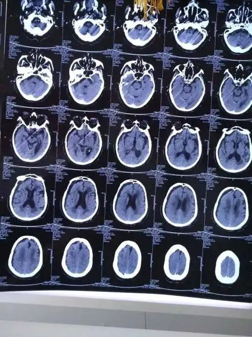 颅脑mri和颅脑ct显示,脑梗塞,硬膜下积液,外伤性脑内血肿,脑萎缩,住院