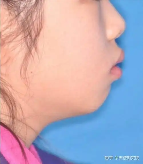 一,凸嘴发病率非常高,但未被重视