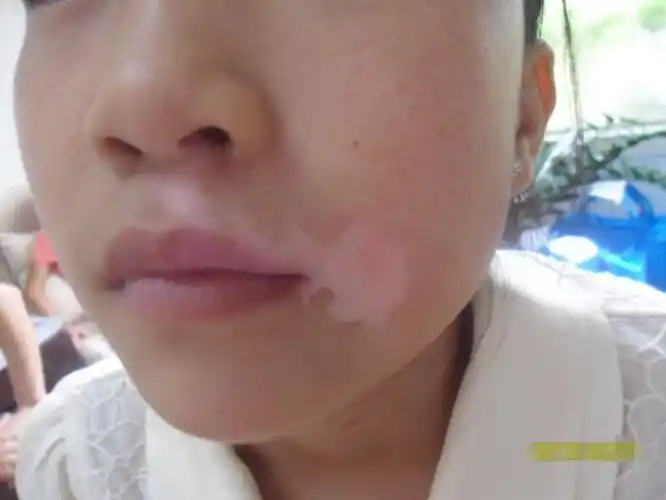 16岁妙龄女孩 鼻下白斑3年余_合肥华夏白癜风研究院附属中医医院