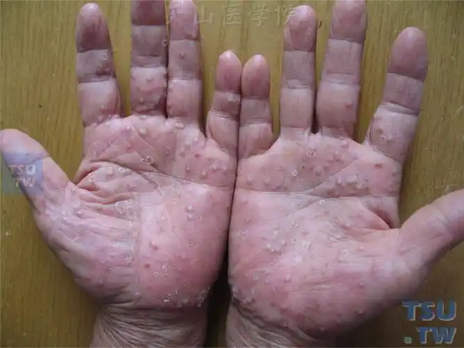 掌跖脓疱病palmplantarpustulosis的症状表现