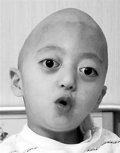 头颅外伤性头痛 _症状库_飞华健康网