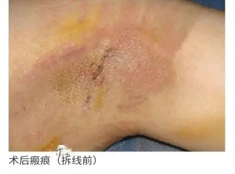 【医疗新技术】县人民医院丨胃肠外科腋臭微创治疗|手术|瘢痕|狐臭