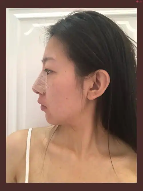 成都菲尔瑞杨树楷做的鼻子整形,一个鼻子拯救整张脸!_美啊美