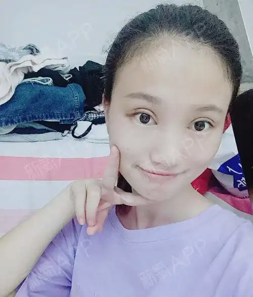 【眼部多项术后第7天】定位:深圳方案:双眼皮 开内眼_圈子-新氧美容