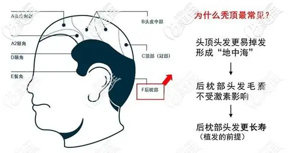 67很多人植发两三年基本脱落了是什么鬼我植发4年