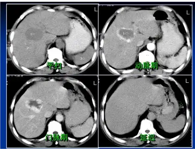 小铭哥   :36 血管瘤 天涯   :36 海绵宝宝 夏威夷的风   :36 海绵状