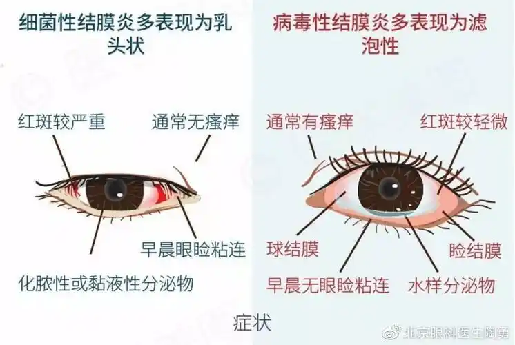 当球结膜下液体增多,或回流受阻时,球结膜就会水肿鼓起来,外观类似