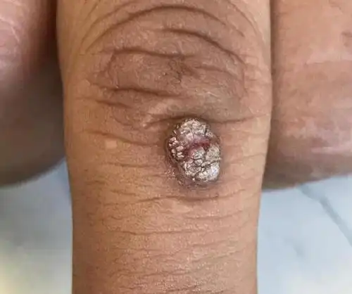 我手上的瘊子这么多,怎么治疗才可以去根啊!